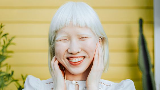 Albinism: Types, Symptoms and Causes
